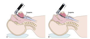 proper position of laryngoscope