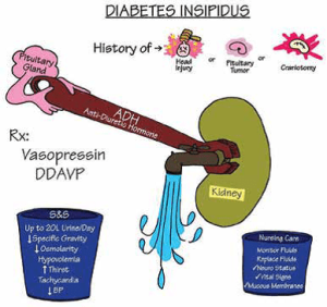 diabetes insipitus