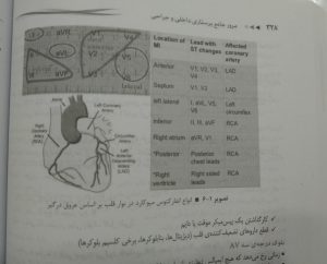 انواع انفارکتوس میوکارد در نوار قلب بر اساس عروق درگیر